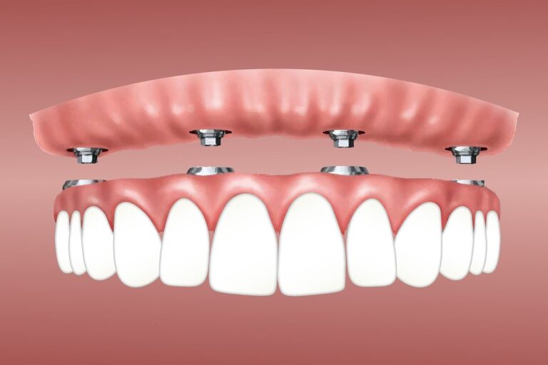 overdenture-3597628_1280